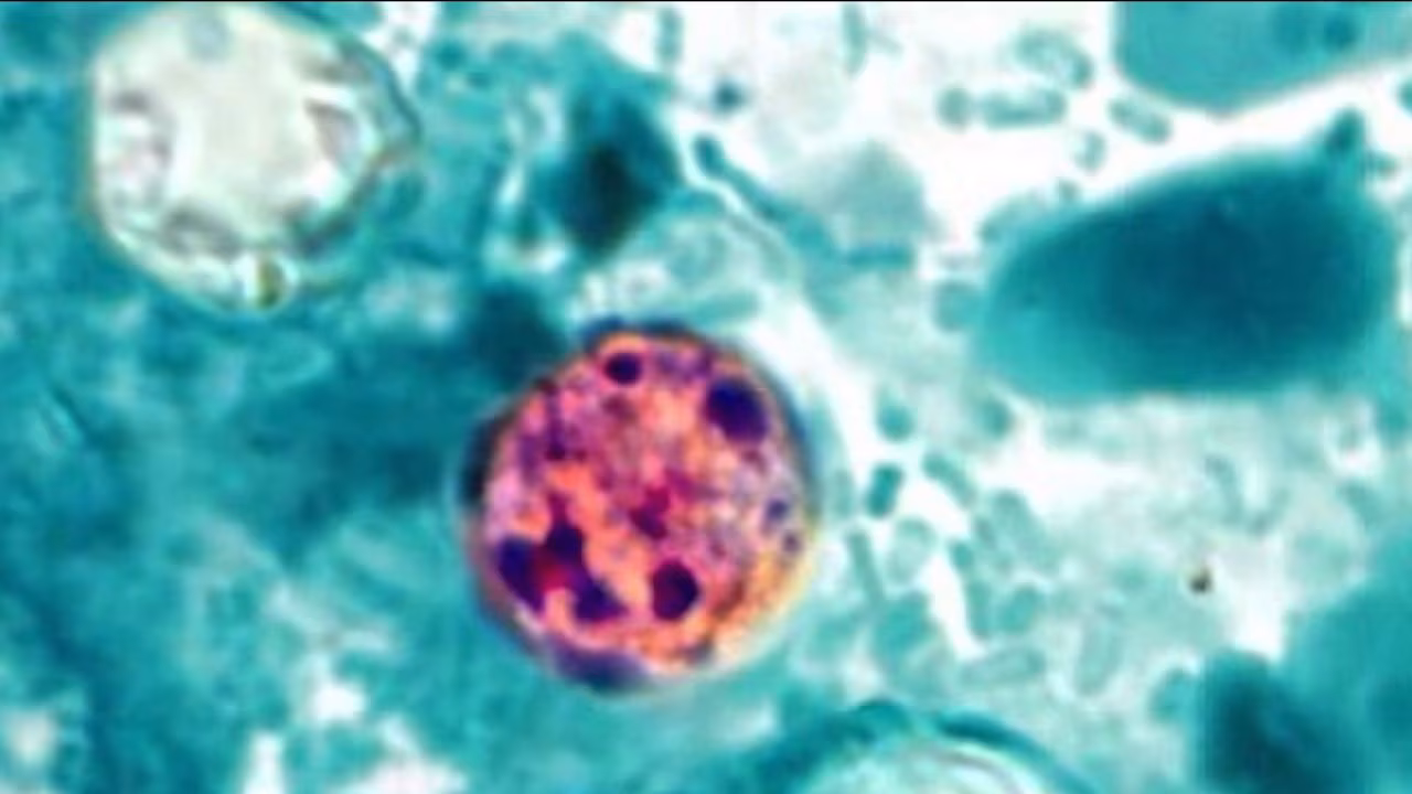CDC Warns of Cyclosporiasis Surge as More Than 5,100 Suspected Cases Are Investigated