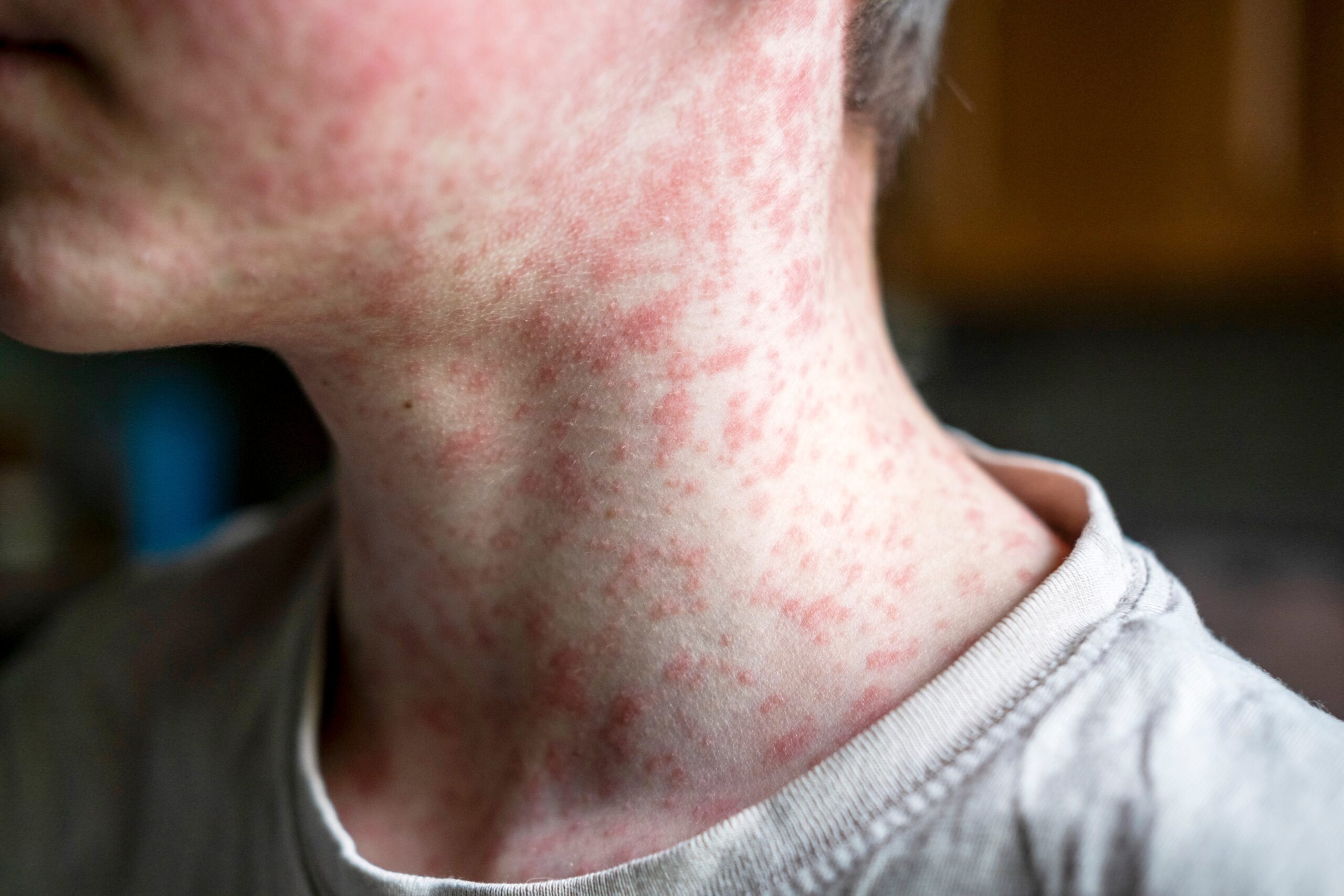 Pennsylvania Measles Outbreak Approaches 800 Cases as Hospitalizations Rise
